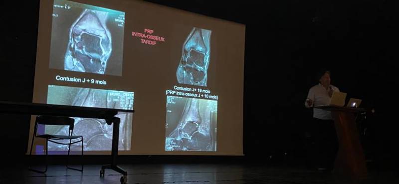 Intervention du Docteur Christophe Cermolacce, chirurgien orthopédiste (Paris - Marseille), aux Journées de Médecine et de Traumatologie du Sport, à Ajaccio
