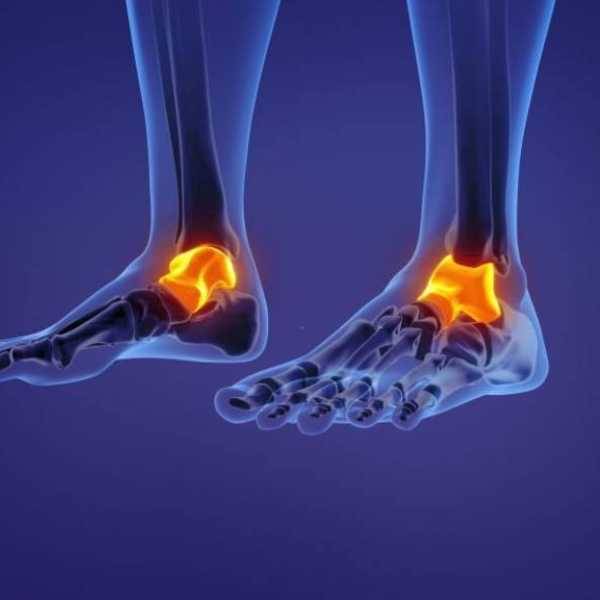 Lésions ostéochondrales du dôme du talus