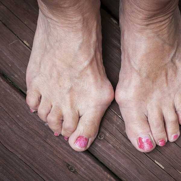 Hallux Valgus