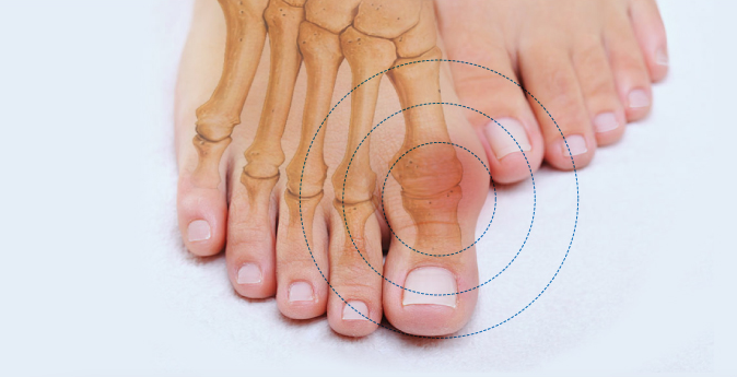 L'avant Pied - L'hallux rigidus ou l'hallux limitus