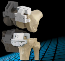 Notre zone d'activité pour ce service Pose d'une prothèse de genou ou d'une prothèse de hanche