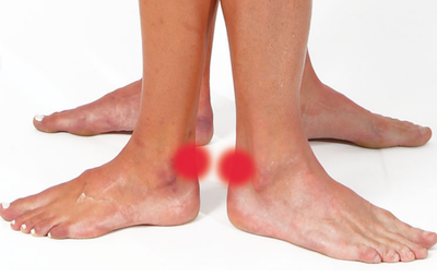 Notre zone d'activité pour ce service Opération du tendon d'Achille