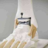 Notre zone d'activité pour ce service Opération pour pose de prothèse inversée d'épaule