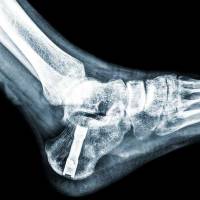 Notre zone d'activité pour ce service Opération pour pose de prothèse inversée d'épaule